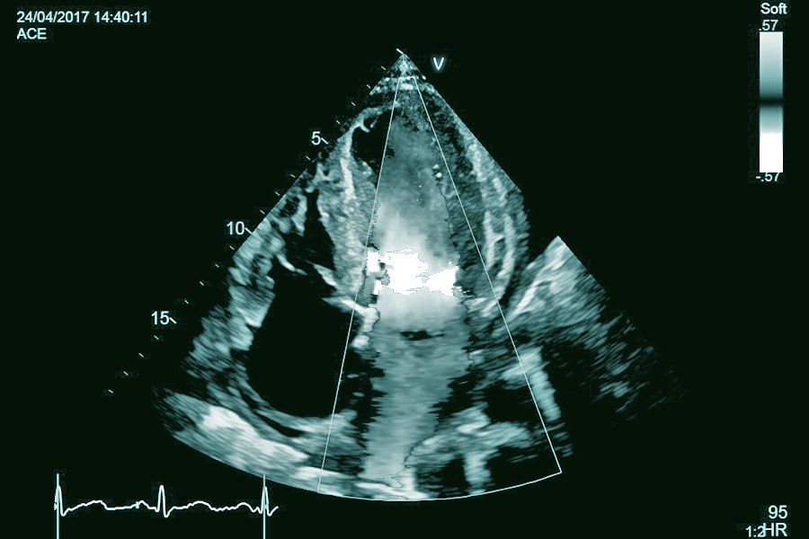 Echokardiographie Ultraschall des Herzens Cardio Health