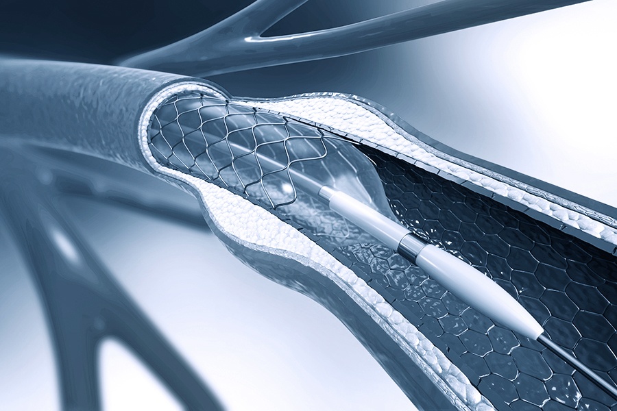 Herz Katheder Untersuchung Stent Implantation